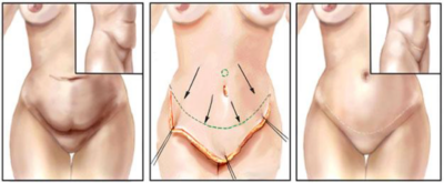 abdominoplastika